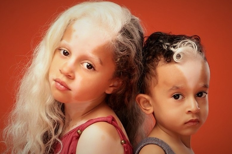 Agência de modelos chama atenção para o Dia Mundial do Vitiligo